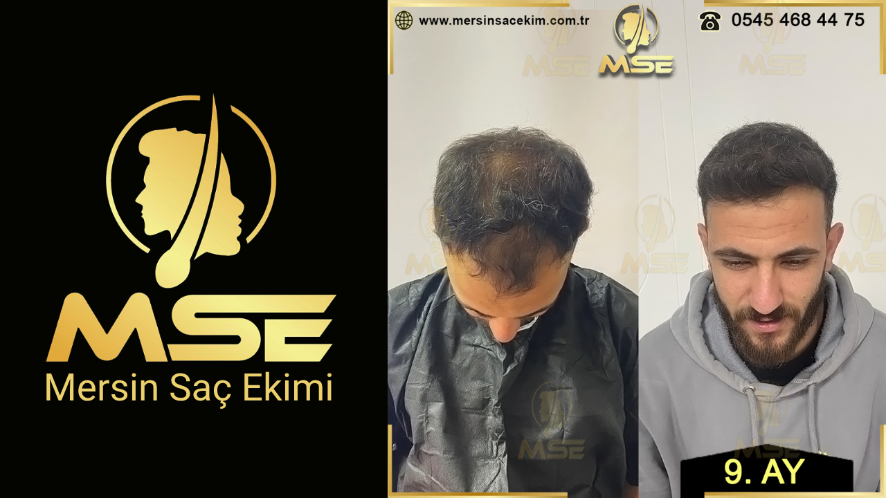 MERSİN SAÇ EKİMİ